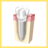 �C���v�����g����
